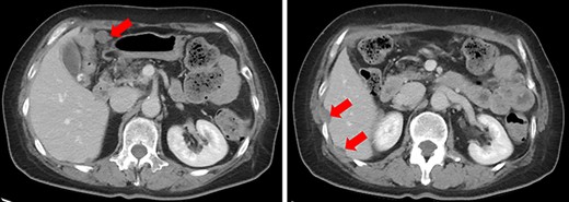 Enhanced CT. Numerous nodules were confirmed throughout the abdominal cavity (red arrows).