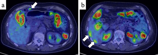 Positron emission tomography and CT (PET/CT) (a) PET/CT showed a nodule with mild FDG uptake in the peritoneum (SUVmax = 3.0) (white arrow). (b) Two nodules with mild FDG uptake (SUVmax = 3.8 and 4.1, respectively) were confirmed around the liver (white arrows).