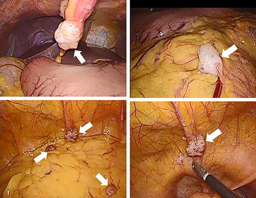 Intraperitoneal observation. Numerous white nodules are found in the peritoneum, omentum and Douglas fossa (white arrows).
