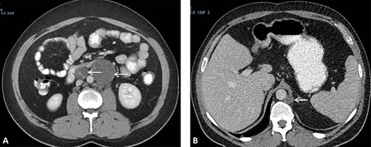 (A) CT scan showing two retroperitoneal masses. (B) CT scan showing retroperitoneal recurrence..