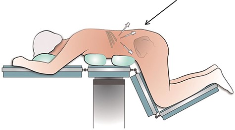 Schematic positioning of a patient in the prone position during the retroperitoneoscopic procedure to excise the RRTM. *Arrow is directed at the port positions; in the middle the camera port is shown.
