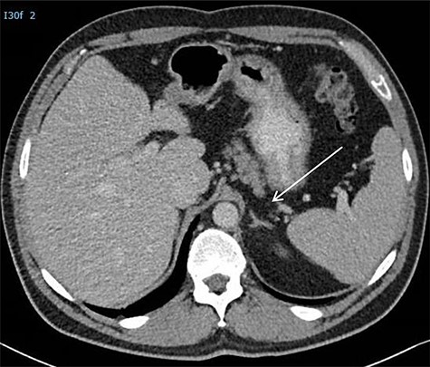 CT scan postoperatively. *Arrow is directed at the adrenal which was not damaged during the procedure.