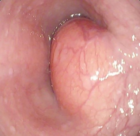 Upper gastrointestinal endoscopy showing submucosal lipoma of the distal esophagus extending between 29 and 39 cm from the incisors.
