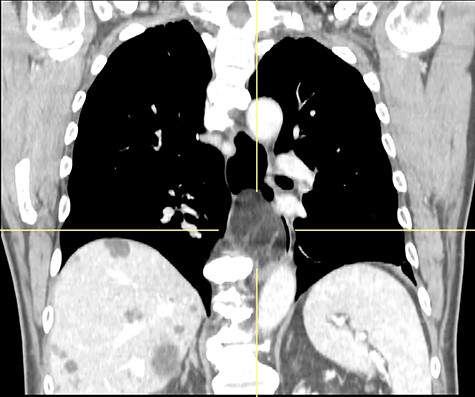CT scan showing fat-density submucosal mass with luminal narrowing.