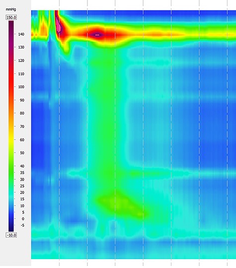 Pre-operative high-resolution manometry showing pan-esophageal pressurization in 100% of the swallows.