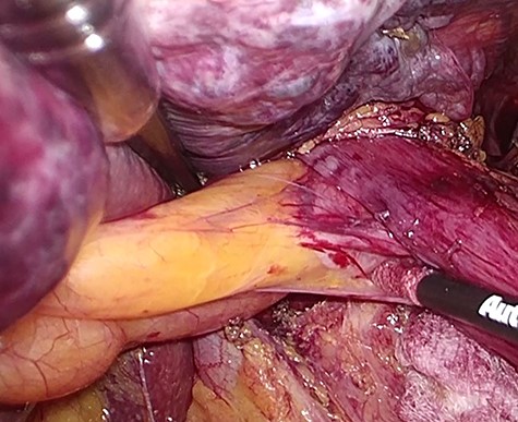 Laparoscopic transhiatal enucleation of an intramural distal esophageal lipoma.
