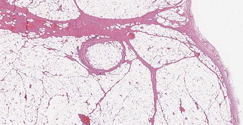Microscopic transverse section revealing a benign tumor composed of a large amount of mature adipocytes with a flat peripheral nucleus without atypia, surrounded by fibrous tissue and containing rare blood vessels (H&E stain, ×10).