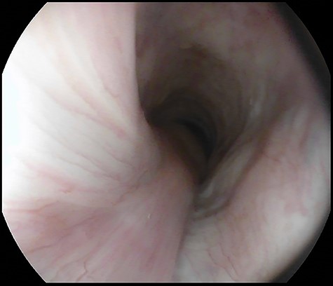 Pre-operative upper gastrointestinal endoscopy showing pedunculated lipoma arising 1 cm below the upper esophageal sphincter and extending from 18 to 26 cm from the incisors.