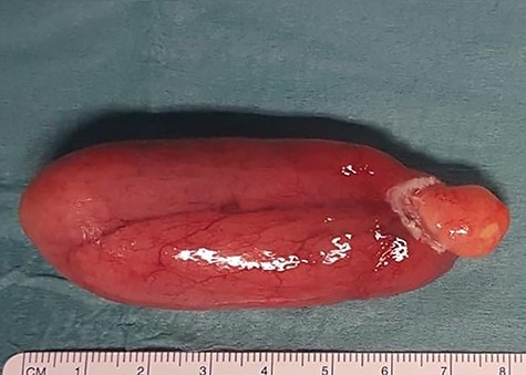 Operative specimen of the pedunculated esophageal lipoma measuring 8 × 3.5 cm.