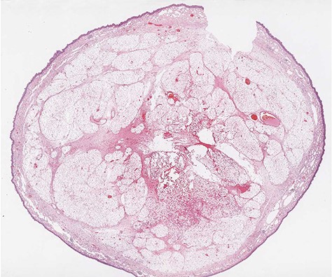 Microscopic transverse section of the pedunculated lipoma composed by mature adipocytes, interspersed by blood vessels, surrounding a central fibrovascular axis; Tumor covered by intact esophageal squamous mucosa. No spindle cells are present. (H&E stain, ×4).