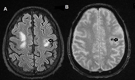 (A) T2-weighted MRI axial image showing left parietal isointense lesion with surrounding edema (black arrow); (B) T2-weighted MRI axial gradient echo sequence showing left parietal lesion compatible with hemorrhagic foci (black arrow).