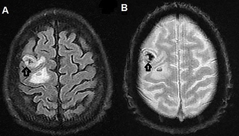 (A) T2-weighted MRI axial image showing right parietal isointense lesion with extensive surrounding edema (black arrow); (B) T2-weighted MRI axial gradient echo sequence showing left parietal lesion compatible with hemorrhagic foci (black arrow).