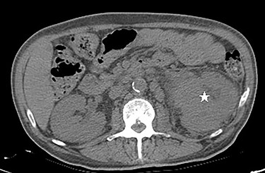CT abdomen/pelvis revealing left renal pelvis mass (asterisk).