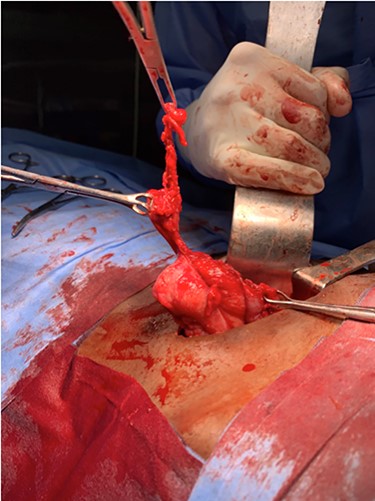 Perforated necrotic sloughed out gangrenous appendix near the ileocaecal junction in the right Iliac fossa with omental adhesions.