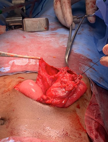 Terminal ileal wall and caecal wall perforations noted after release of adhesions.