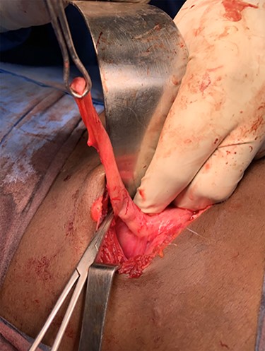 Terminal ileal and caecal wall perforations closed primarily in two layers: second incidentally identified appendix held with Babcock forceps and appendectomy stump of perforated appendix (artery forceps).