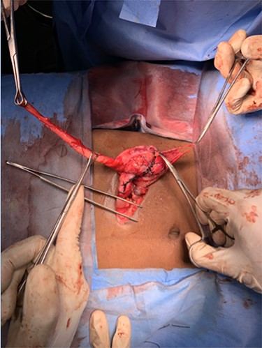 On thorough caecal examination and blunt dissection, incidentally an acutely inflamed second appendix was visualized to be arising from lateral wall of caecum.