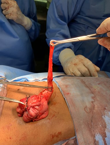 Base of second acutely inflamed appendix was found to be branching 4 cm from the stump of perforated appendix along line of taenia coli.