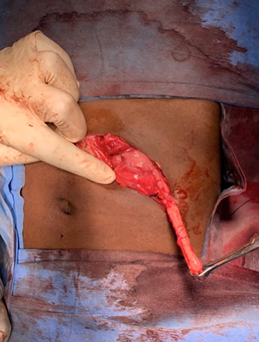Release of lateral peritoneal attachments to caecal wall to complete appendectomy of the second appendix.