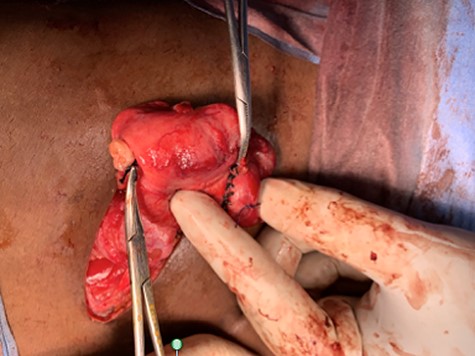 Completed second appendectomy with two appendectomy stumps in the caecum along taenia coli.