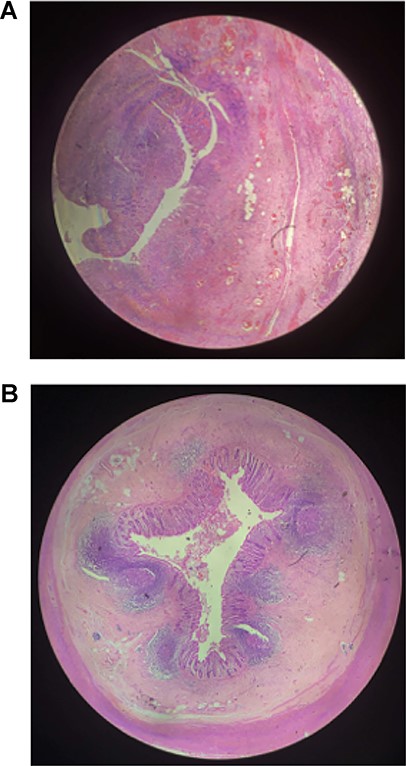 Histopathological examination (H&E stain; ×40 magnification): (a) appendix exhibiting extensive mucosal ulceration with suppurative transmural dense acute inflammation with area of perforation and (b) appendix showing focal ulceration of lining mucosa with lymphoid hyperplasia and mild transmural inflammatory infiltrate.