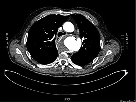 CT scan demonstrating close relationship of oesophagus and aortic aneurysm sac.