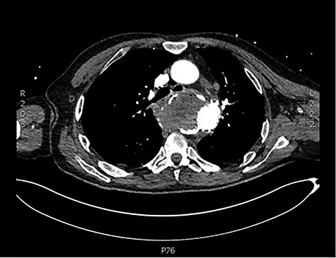 Angiography scan demonstrating TEVAR stent position.
