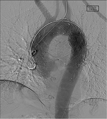 CT scan demonstrating patent stent with no suggestion of endoleak and lack of contrast in aneurysm sac.