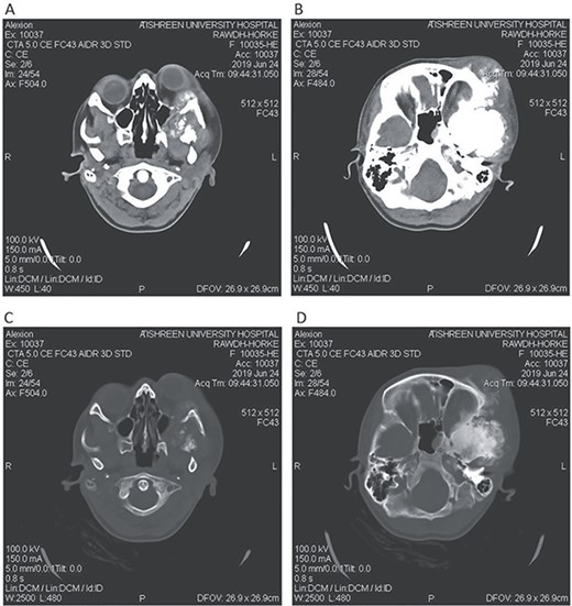CT head tissue window (A, B). A. Invasion of the maxillary sinus and orbit. B. Invasion of the parietal, temporal and frontal lobes. A remarkable exophthalmos. Bone window (C, D). C. The bone-forming lesion showing the same density of the bone. D. Invasion of the sphenoid, temporal and parietal bones.