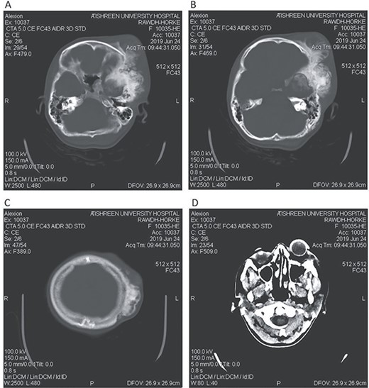 CT head bone window (A–C). A. Invasion of the frontal bone. B. Invasion of the orbit. C. Invasion of the parietal bone. D. Invasion of the sphenoid, temporal and parietal bones.