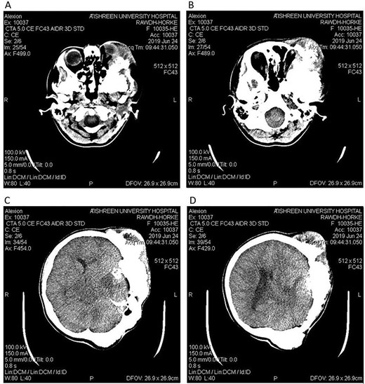 CT head tissue window. A, B. Invasion and destruction of the surrounding tissue. C. Minor shift of the elements of the midline to the right side due to the edema. D. The edema applies pressure to the left lateral ventricle.