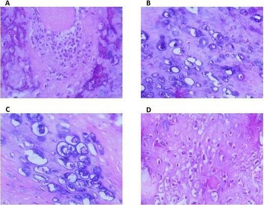 A. Low-power magnification of the tumor showing proliferation of chondroid tissue with scattered areas of osseous differentiation. (H&E stain, ×100). B. The chondroid matrix exhibiting atypical chondroblasts and chondrocytes with large pleomorphic nuclei and prominent nucleoli (H&E stain,×200). C. The tumor cells are present in lacunar spaces. The periphery of the cartilaginous area (lower left) shows spindling of the tumor cells (H&E stain, ×400). D. Presence of epitheliod and spindle neoplastic osteoblasts with large hyper chromatic nuclei and few mitotic figures. (H&E stain, ×200).