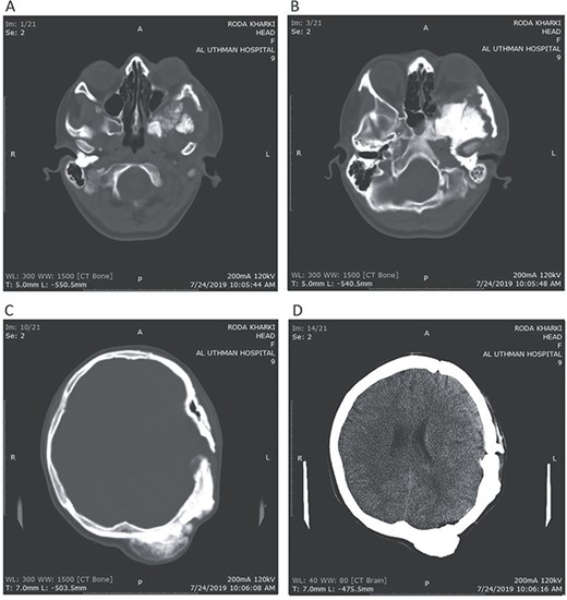 Postoperative CT head bone window (A–C). A. Regression of the pressure on the maxillary sinus. B. Decline of the exophthalmos. C. The parietal bone after excision of the masses. Tissue window (D). Regression of the pressure on left lateral ventricle and decline of the midline shift.