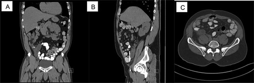 CT scan shows acute appendicitis. Dilated fluid-filled appendix measuring up to 2.4 cm in diameter × 8.3 cm in length with periappendiceal inflammation ((A) Coronal view, (B) sagittal view, (C) axillary view).