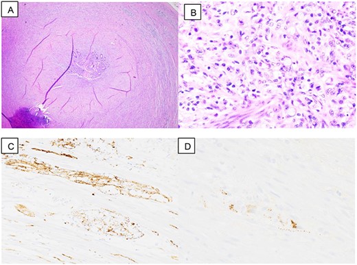 Pathology slides are: (A) low power view: appendix with thicken wall, (B) high power view: signet ring cell, (C) synaptophysin stain: positive and (D) chromogranin stain: focally positive.