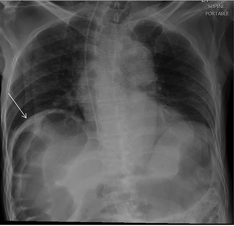 chest X-ray revealed visualized part of the abdomen demonstrate distended bowel filled with gases under the right hemidiaphragm.