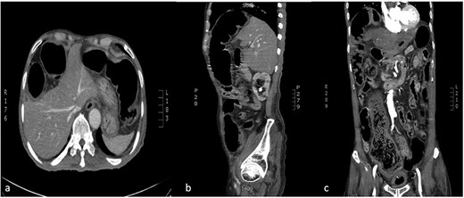 CT abdomen (a:axial) (b:sagittal) (c:coronal): transposition of a large bowel loop between the right hemidiaphragm and liver denoting Chilaiditi sign.
