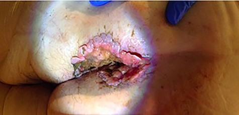 Photograph of the perianal lesion on presentation.