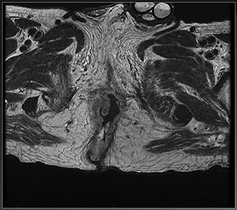 MRI of pelvis showing extension of tumor through the right external sphincter.