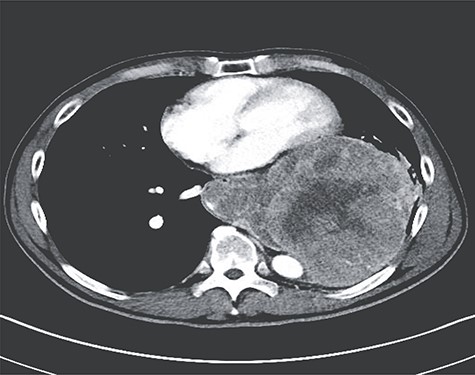 Axial image from preoperative CT of the chest demonstrating extension from esophagus and relation to the pericardium and thoracic aorta.