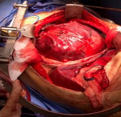 Thoracoabdominal exposure of esophageal SFT.