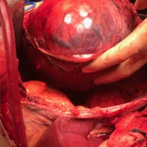 Dissecting the tumor from the chest cavity.