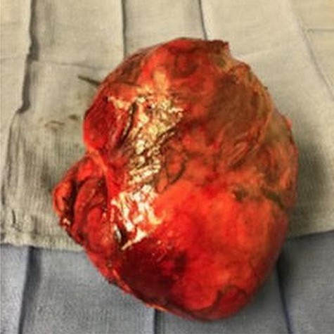 Eighteen-centimeter size tumor, 2 kg in weight.