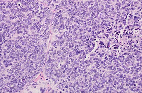 Microscopic pathology of the tumor.