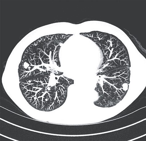 One-year postoperative CT showing metastases to the lungs.