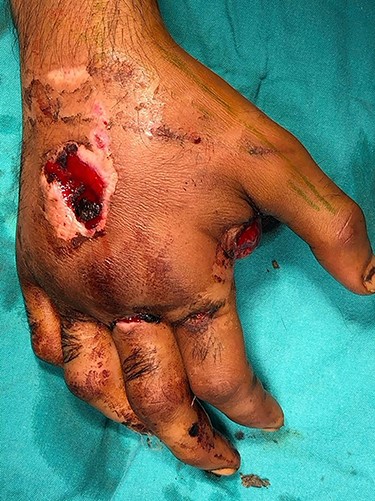 Exterior view of the hand before the operation.