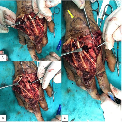 Exposing the metacarpal fractures. In the second (C), third (B) and fourth (A) fingers and intact tendons. Flap marking intraoperatively: yellow arrow.