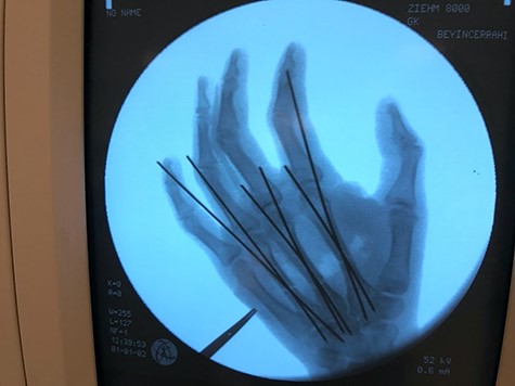 After stabilization with two K-wires per fractured finger.