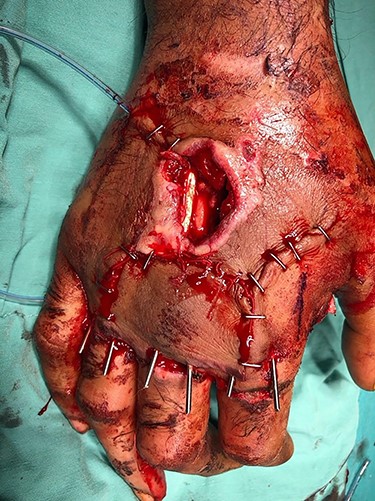 Defective area after fixation and skin suturing.