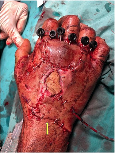 The flap inset. Yellow arrow: donor site closed with primary closure.